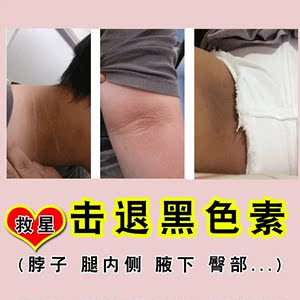 脖子黑色素沉淀的实时信息