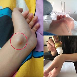 健鞘囊肿专用正品手腕鼓包腱鞘炎药膏痛舒大拇指舒筋贴关节痛贴膏