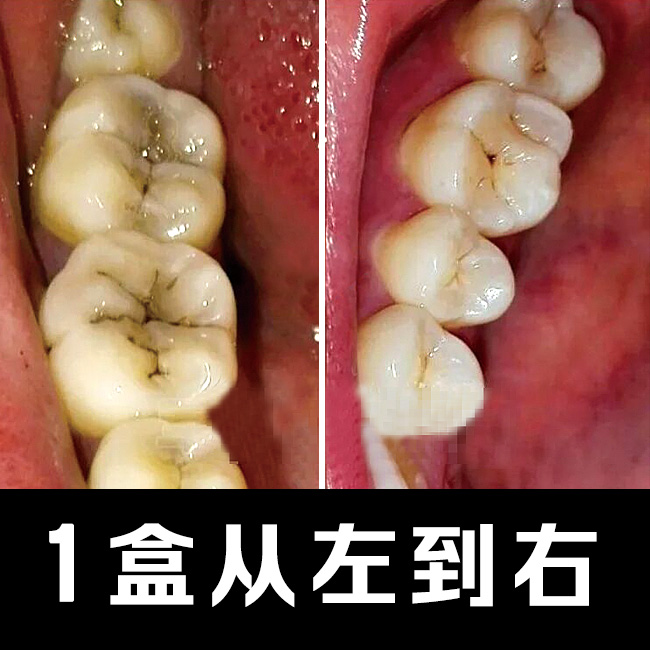 防蛀牙修复牙洞膏虫牙龋齿修复成人儿童防蛀牙黑斑牙疼牙痛护牙粉
