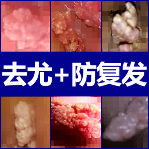 犹敌尖锐疣湿疣特效防复发男女私处 span class=h>鬼臼 /span> span