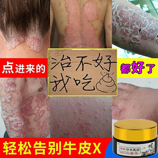 牛皮鲜藓银屑外用成人止痒软膏湿疹老偏方皮肤头部膏股藓脚癣药膏