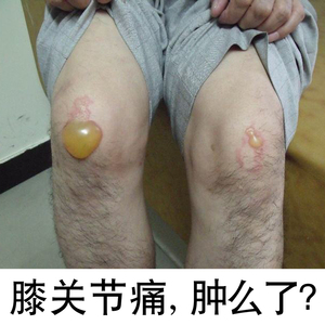 膝盖疼关节痛 span class=h>贴 /span>半月板积水 span class=h>积液 