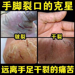 手裂手腳開裂脫皮乾燥愈裂霜後跟手足裂口癒合防乾裂 span class=h>膏