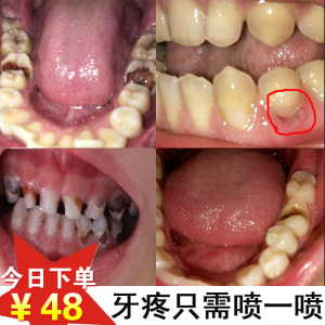 class=h>貝康 /span>成人兒童治蛀蟲噴劑神經牙齦腫痛噴霧修復牙洞