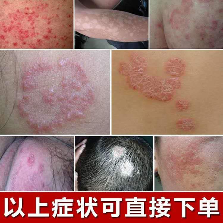 牛皮癬藥膏老偏方治銀屑蘚皮膚外用止癢膏成人溼疹特 span class=h>